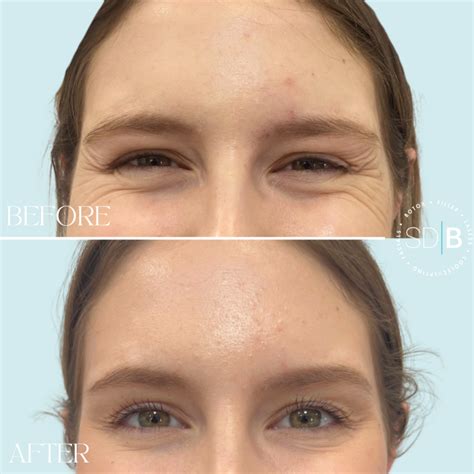 Botox for Crow's Feet: SDBotox Austin Treatment | 2025