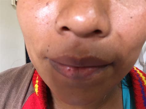 Van der Woude Syndrome | Consultant360