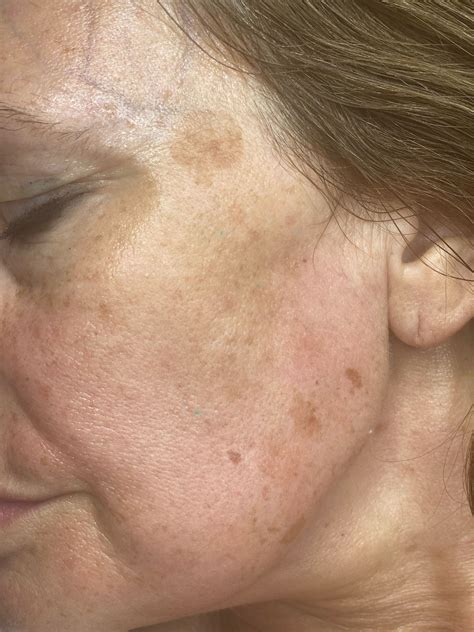 Sunspots On Face Treatment