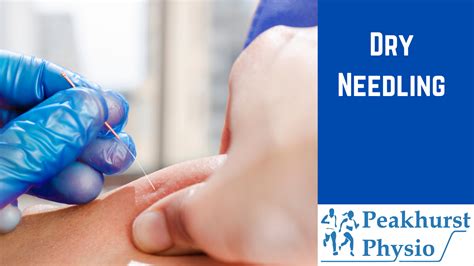 WHAT IS DRY NEEDLING? - Peakhurst Physio
