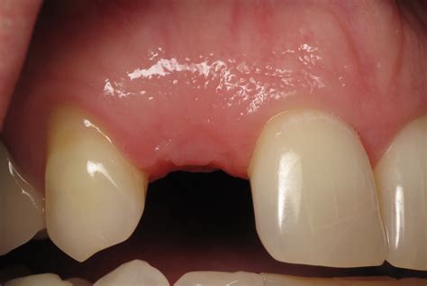 Dental Gum Implants at Tayla Hamlyn-harris blog