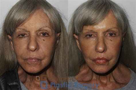 Lip Augmentation Before & After Photos Patient 174 | Washington DC & Arlington , DC | Potomac ...
