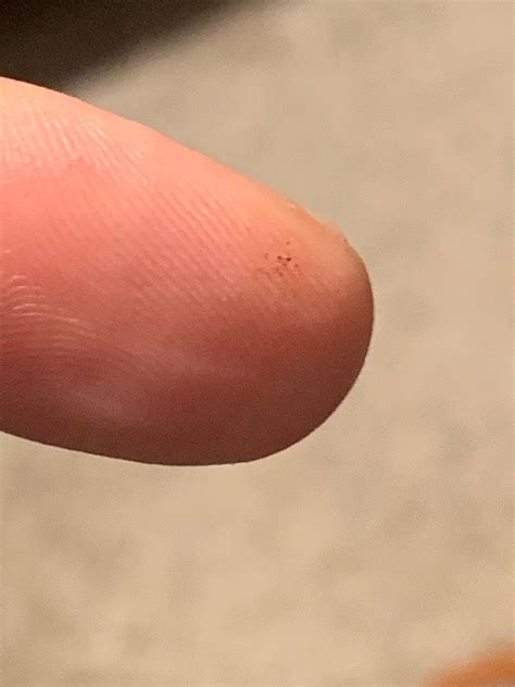 Help Is this a wart on my 5 year old finger? It's stressing me out. : r/Warts