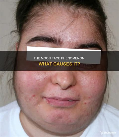 The Moon Face Phenomenon: What Causes It? | ShunSpirit