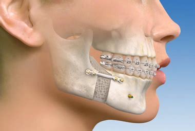 How Did They Wire People'S Jaw Shut For Weight Loss