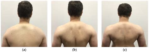 Thoracic Outlet Syndrome: Biomechanical and Exercise Considerations