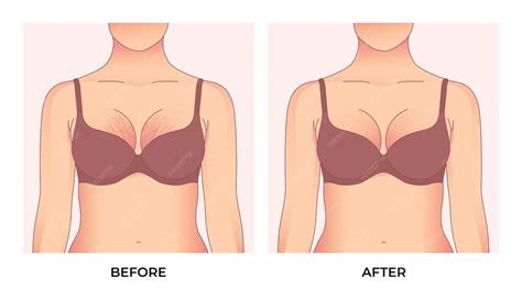 Premium Vector | Woman with stretch marks on breast. Before and after ...