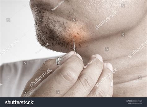 Ingrown Cheek Hair