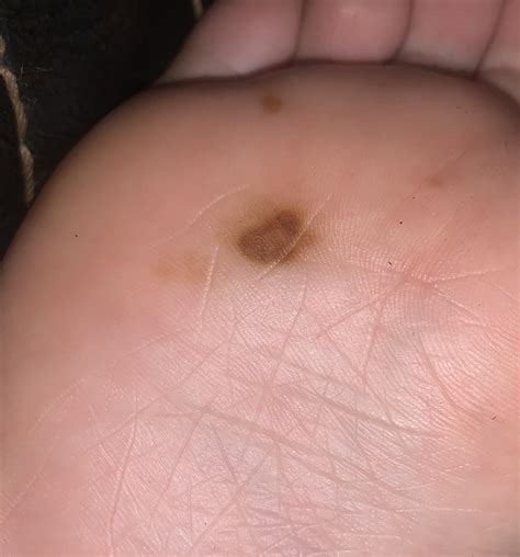 Brown spots appeared suddenly didn’t notice them until I saw the big one, I then noticed the ...