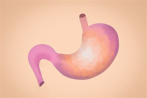 Hypochlorhydria: Low Stomach Acid Symptoms, Causes and Treatment - Bottom Line, Inc.