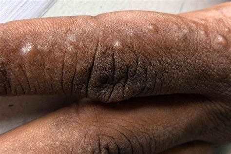 7 Other Causes of Itchy Bumps Besides a Mosquito Bite