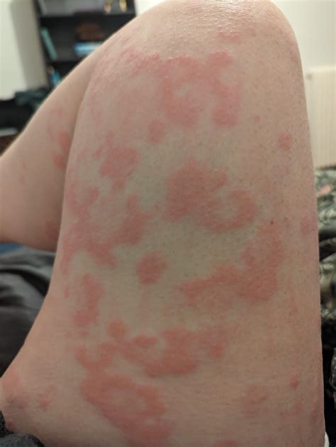 High Neutrophils? : r/urticaria