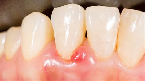 Gingivitis: Signs, Symptoms, Causes and Treatment | Kirkland Premier Dentistry
