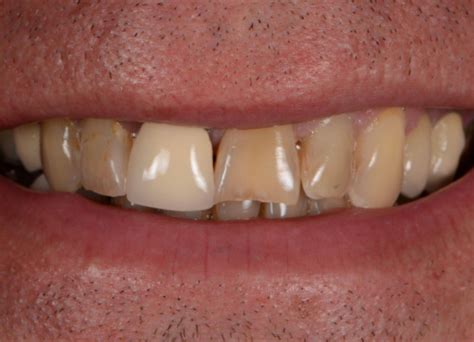 Gum Abscess Popped? Thinking of Popping It Yourself?