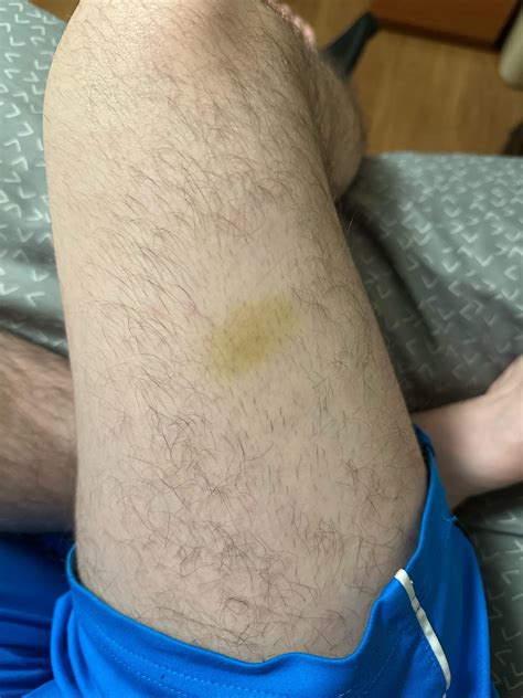 Yellow/Green spot on thigh. Is this a bruise? It doesn’t hurt : r/DermatologyQuestions