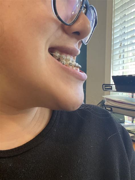 2 weeks post-op DJS for 19mm underbite! : r/jawsurgery