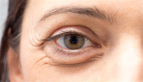 eye bag – botox for eye bags – MKALL