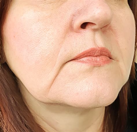 Marionette Lines Treatment | Minneapolis, MN | Metropolitan Skin Clinic