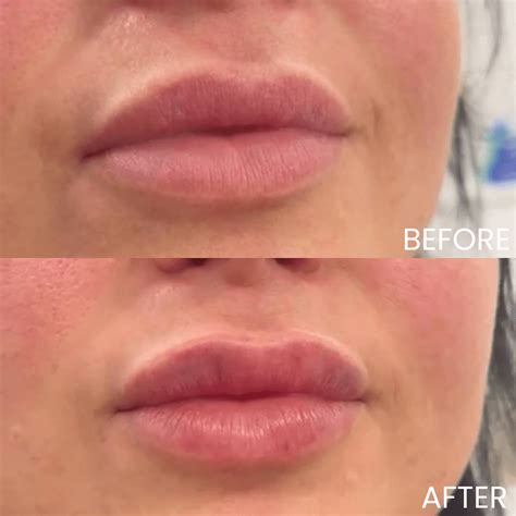 Lip Filler Before and After: MySkyn Clinic