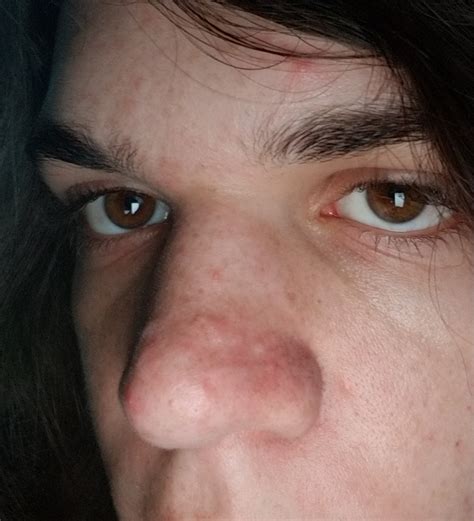 Flesh Colored Bump On Nose