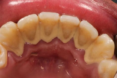 Severe Calculus Teeth
