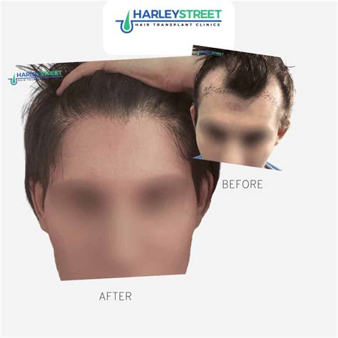 Finasteride For Women - Can Women Take Finasteride? - Harley Street HTC