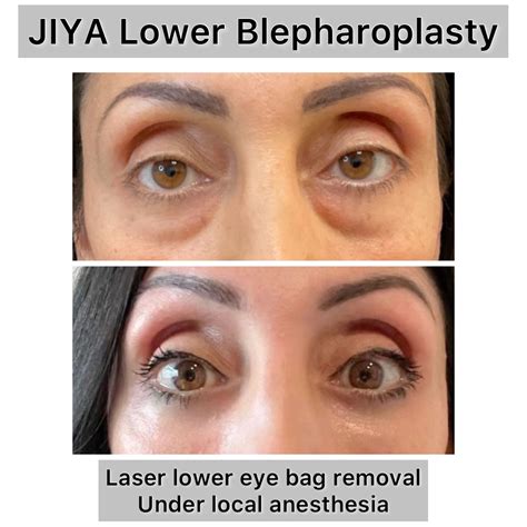 Lower Blepharoplasty Raleigh, NC | Raleigh Eye Lift