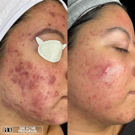 Acne Edit • Modesto Skin Expert | the way our jaw dropped when we ...