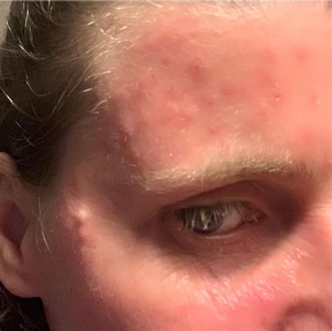 Is it ‘steroid blisters’ or Eczema herpeticum?