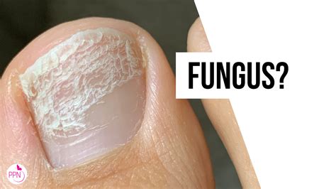 What Can White Spots On Toenails Mean - Design Talk