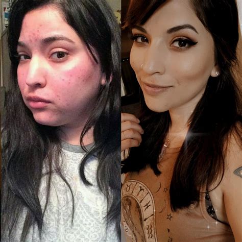 Cushing Syndrome Face Before And After at Stephanie Fleming blog