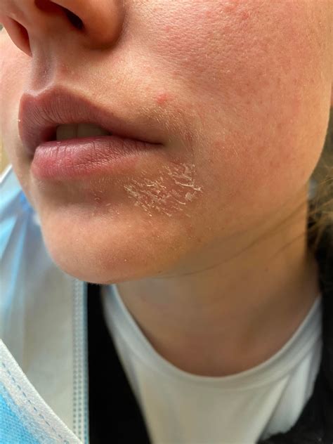 Flaky Skin Skin Peeling: 9 Reasons Your Skin Is Peeling (with
