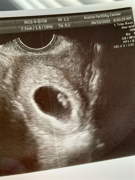 6 Week Ultrasound Heartbeat