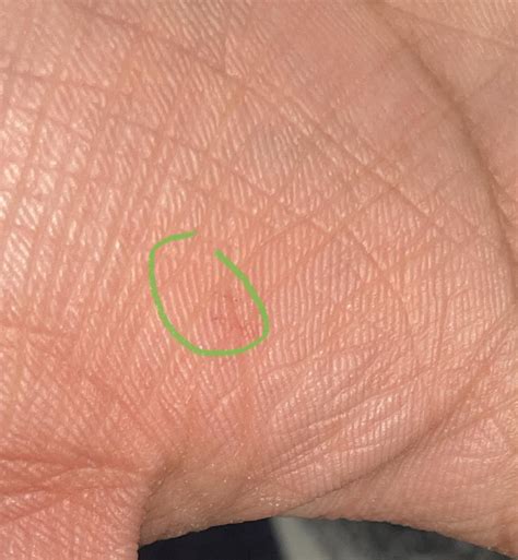 Start of a wart? Three dots under my skin pattern : r/Warts