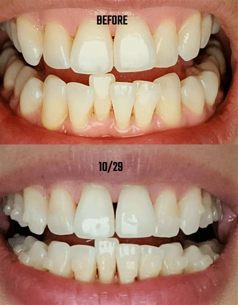How it's going.. Previous Advanced Gum Disease : r/Invisalign