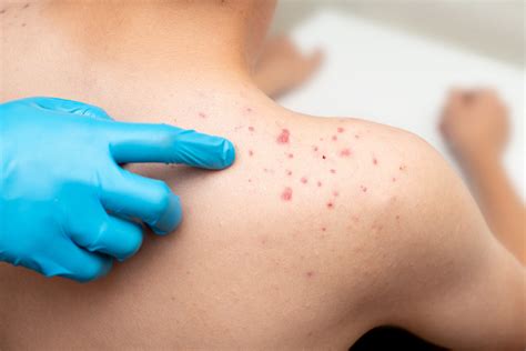 Does Creatine Cause Acne? - Palm Beach Dermatology Group