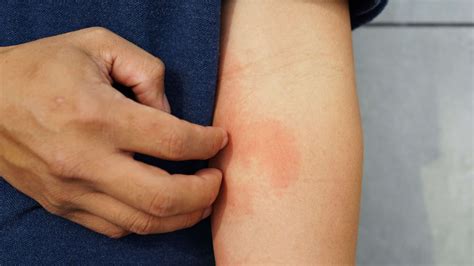 Eczema: Causes, Symptoms, Types, And Treatment