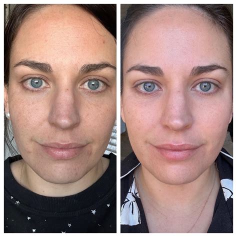 before & after - a years difference : r/tretinoin