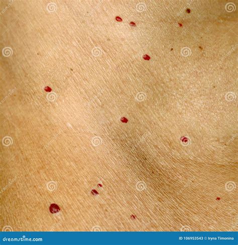 Cherry Angioma On Human Skin Royalty-Free Stock Photography | CartoonDealer.com #86501627