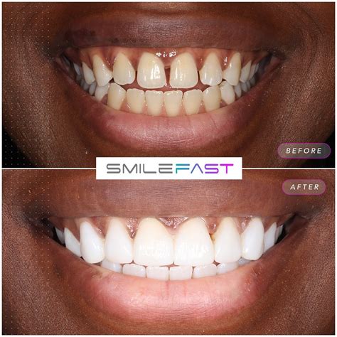 Smilefast® Composite Bonding Treatment Edinburgh | Stockbridge Dental ...