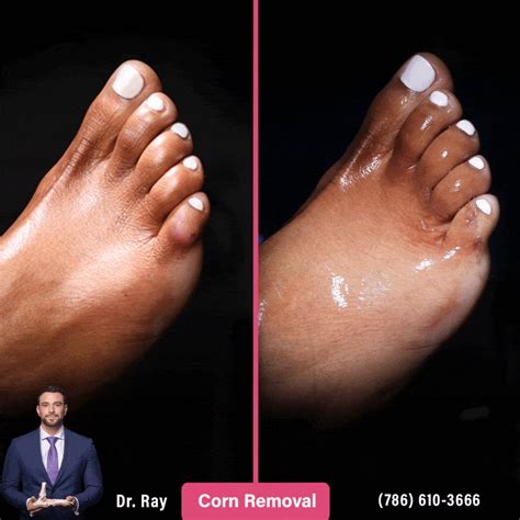 Corn Removal Surgery Before and After Photos - Luxe Foot Surgery