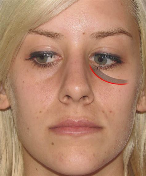 Lines Under Eyes Since Childhood at Joanna Swanner blog