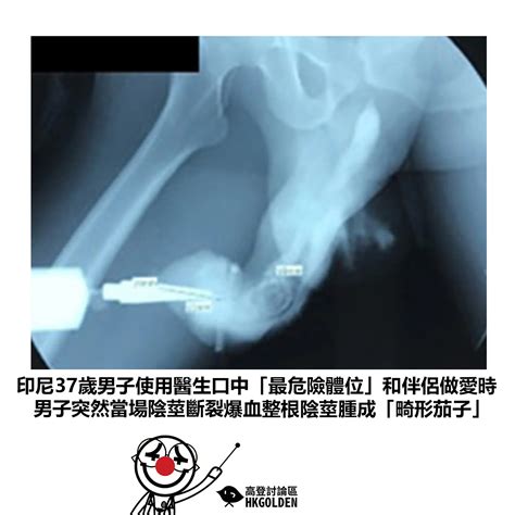 【印尼37歲男子使用醫生口中「最危險體位」和伴侶做愛時 男子突然當場陰莖斷裂爆血整根陰莖腫成「畸形茄子」】 | 高登新聞