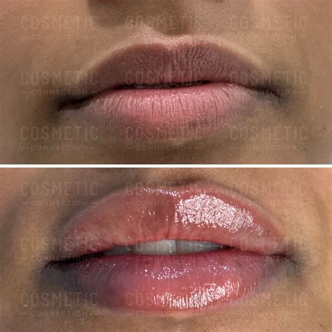 What Does 1Ml Of Lip Filler Look Like at Beth Anker blog