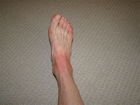 Can Yellow Jacket Stings Cause Cellulitis at Henry Christie blog