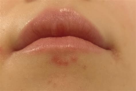 Painful burning bumps under lip (on 20mg accutane for 14 months now ...