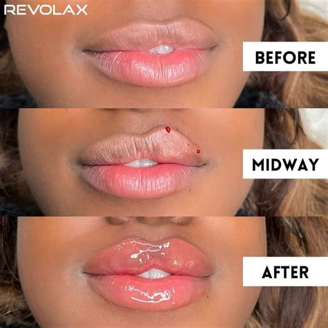 Lip Filler Before and After Photos and Results - the daily glimmer