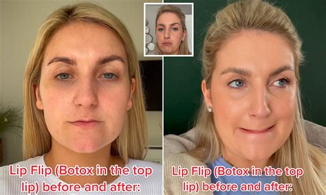 Upper Lip Botox Before And After