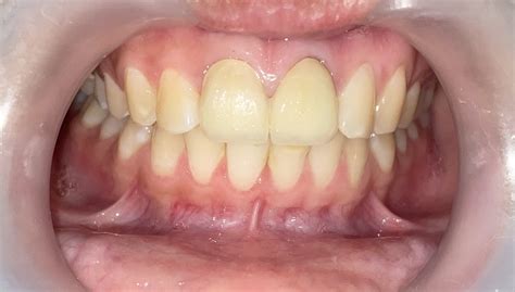 Understanding Dental Trauma: Types, Symptoms, and Treatment of Tooth Injuries