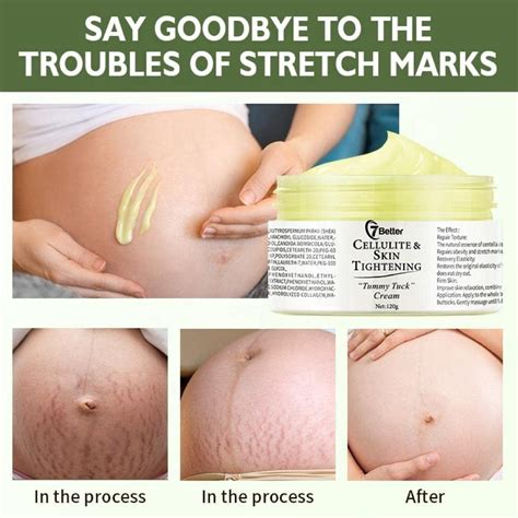 Postpartum Elegance Natural Deep Stretch Mark Removal Cream for ...